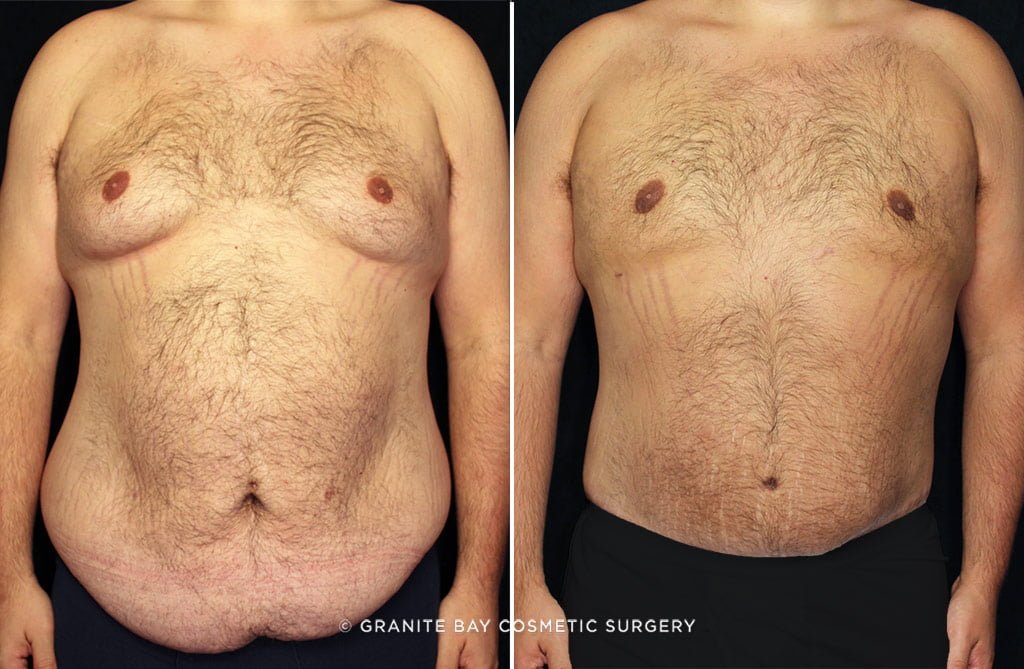 Body Lift with Gynecomastia