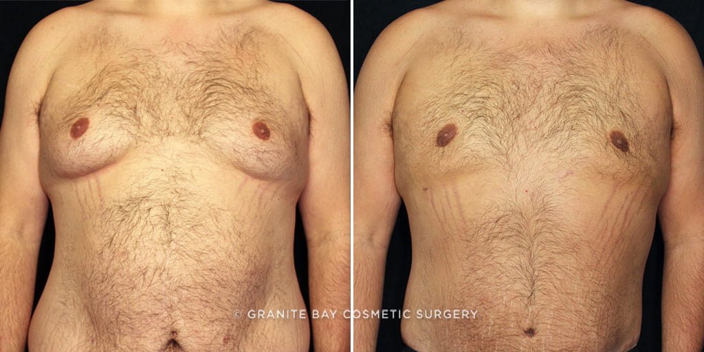 Male Breast Reduction