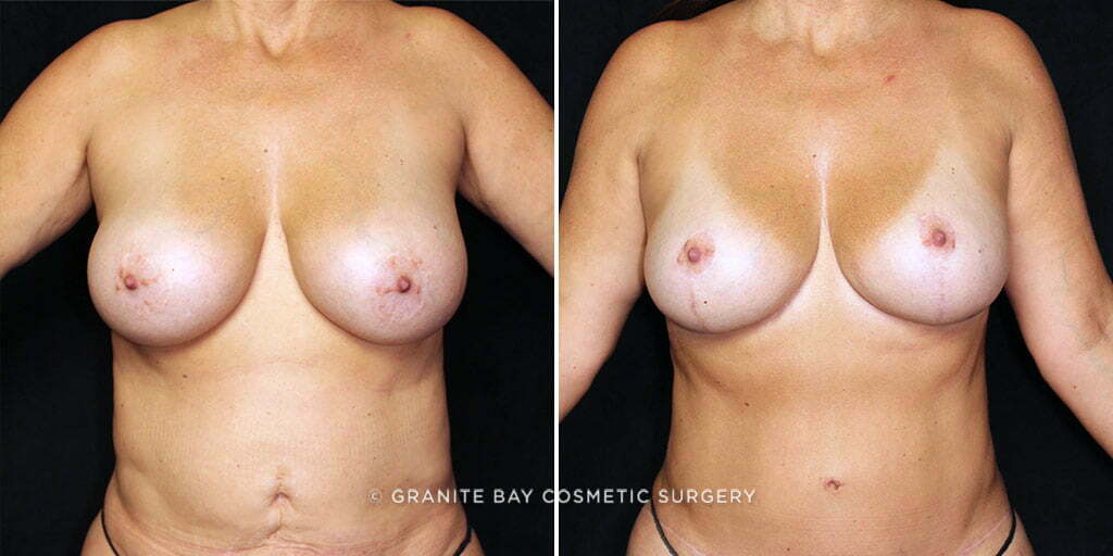MMO Breast Lift with Implant Exchange