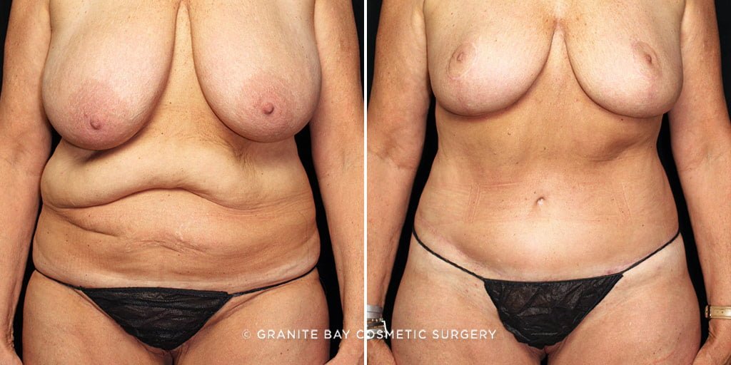 MMO Tummy Tuck