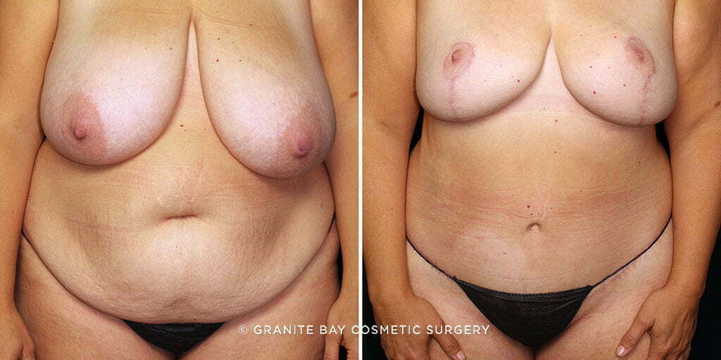 MMO Tummy Tuck