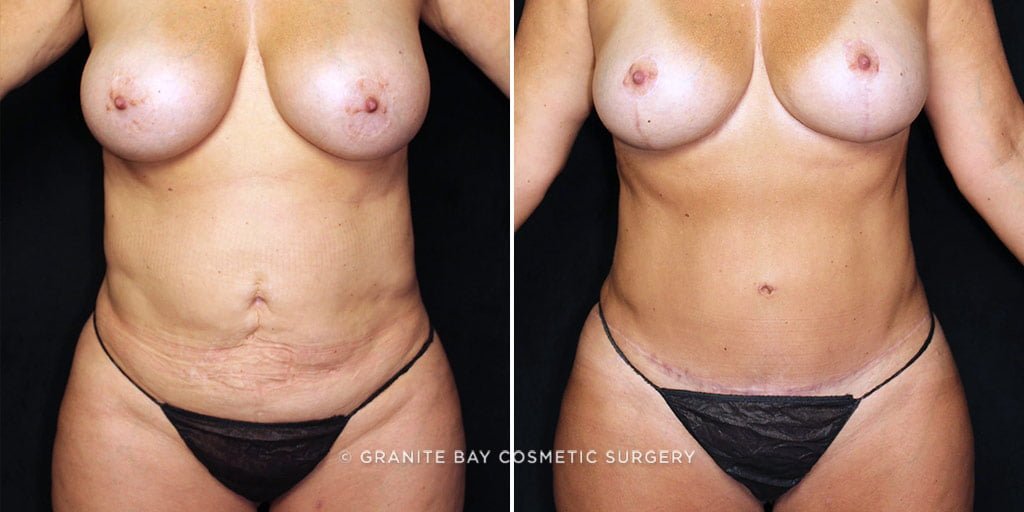 MMO Tummy Tuck