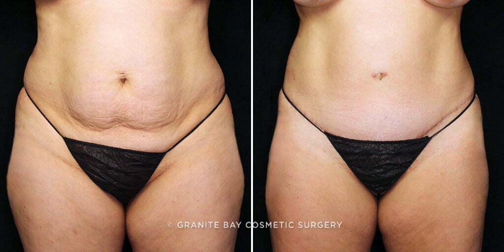 Tummy Tuck with Liposuction