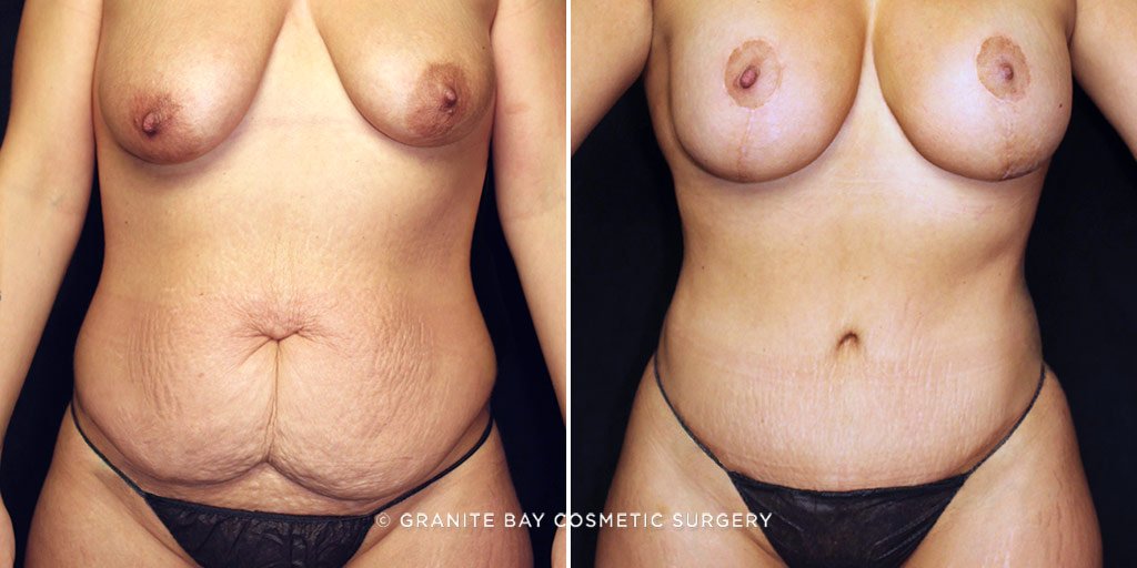 MMO Tummy Tuck