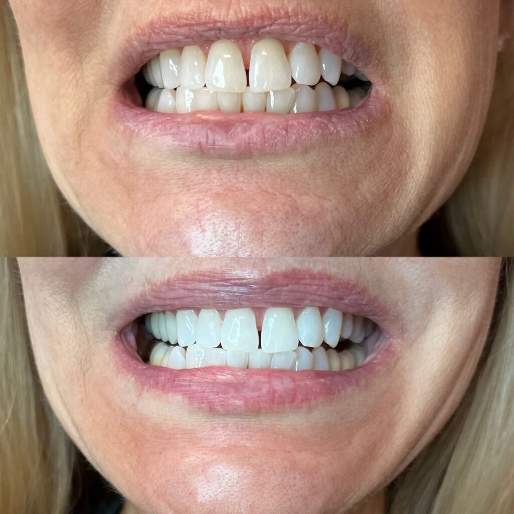 Davinci Teeth Whitening before and after results