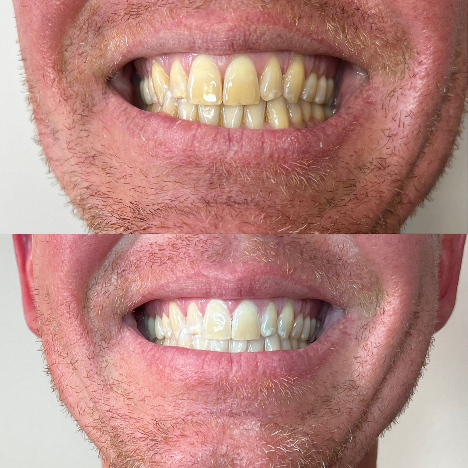 DaVinci Teeth Whitening Granite Bay, CA Granite Bay Cosmetic Surgery