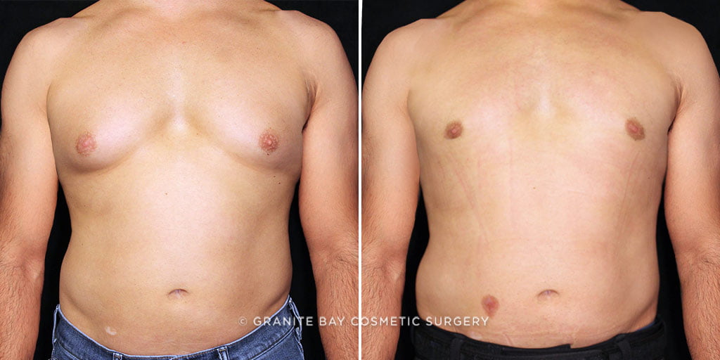 Male Breast Reduction