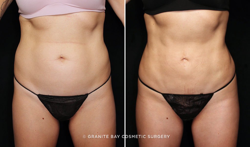 Patient before and after liposuction to the abdomen and flanks