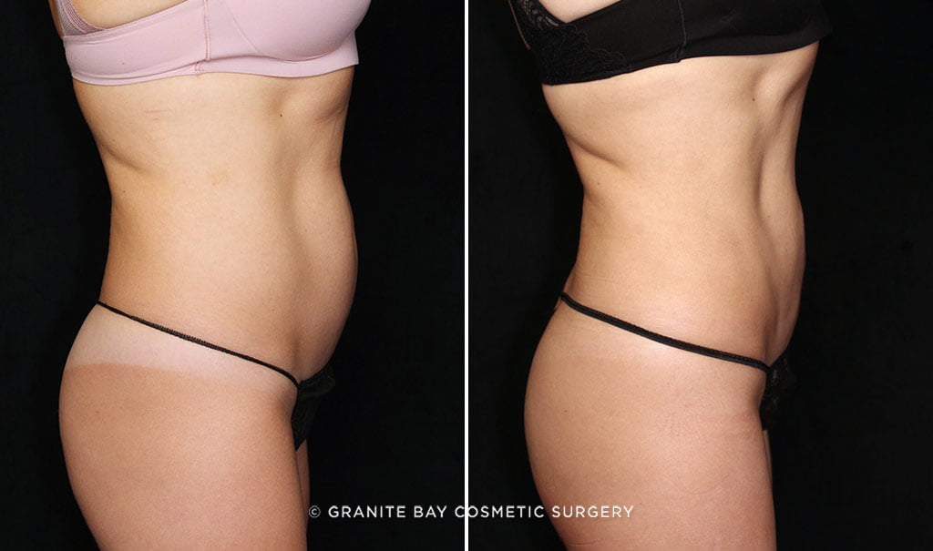 Patient before and after liposuction to the abdomen and flanks