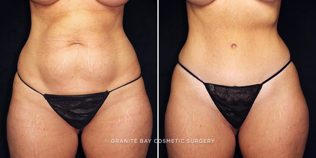 Tummy Tuck