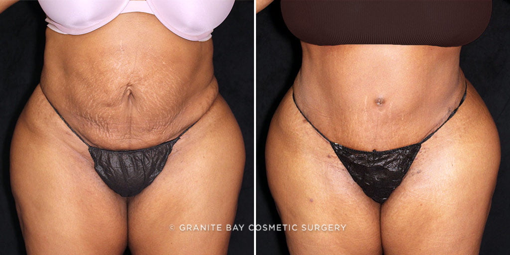 Tummy Tuck