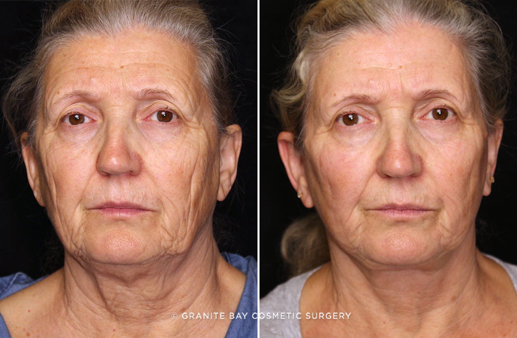 Facelift and Browlift