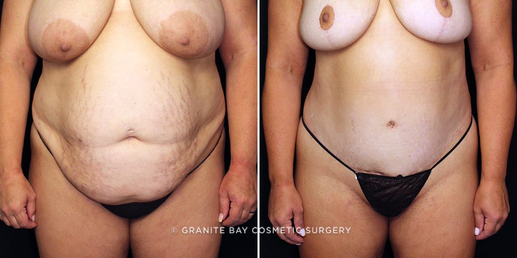 Tummy Tuck