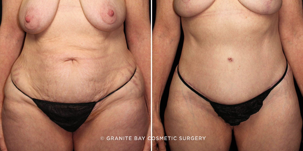 Tummy Tuck