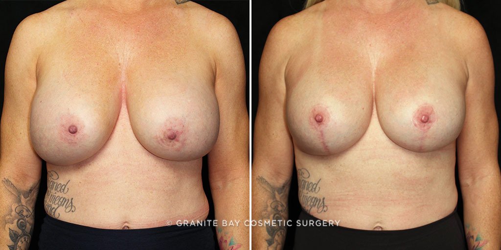 Breast Implant Exchange with Lift