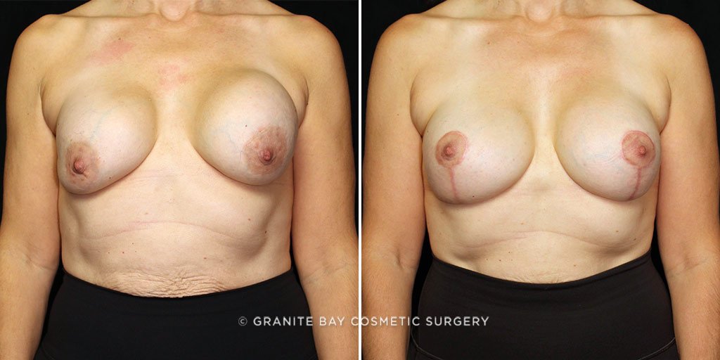 Breast Implant Exchange with Lift
