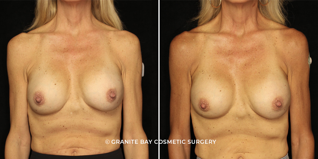 Breast Implant Exchange