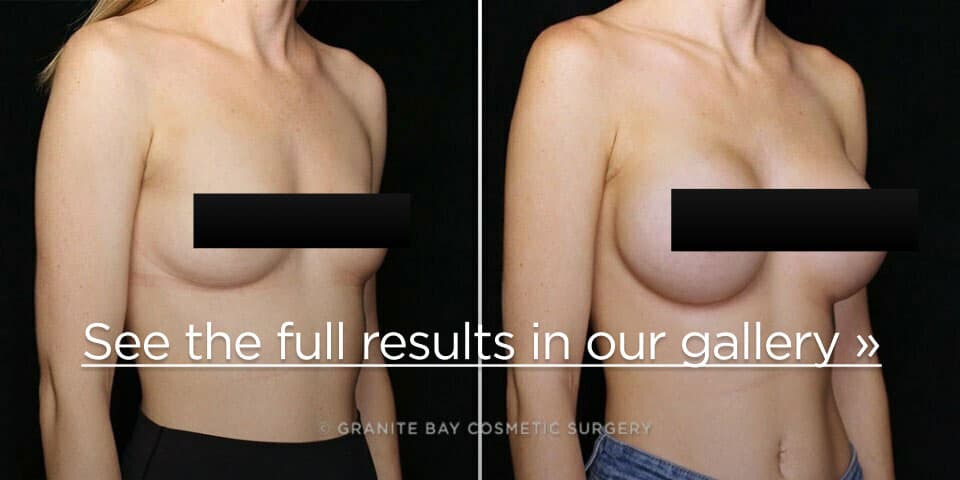 Granite Bay Cosmetic Surgery real patient before and after breast augmentation with implants