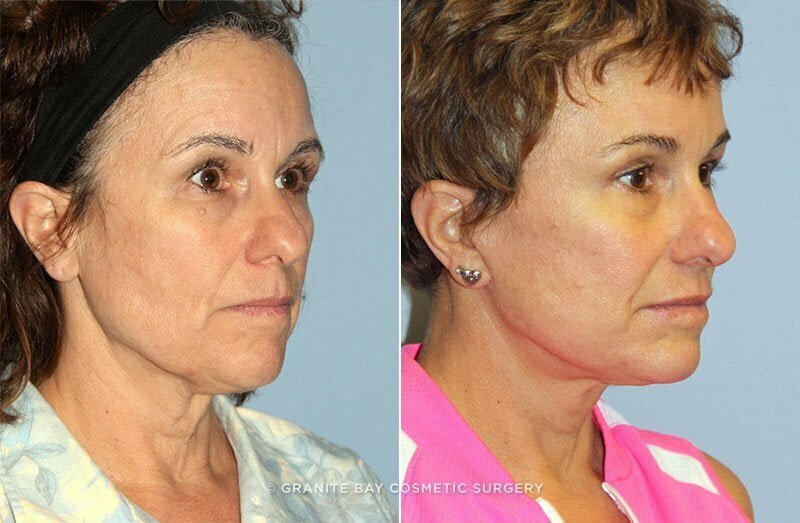 Before and after eyelid lift, lower face and neck lift at Granite Bay Cosmetic Surgery