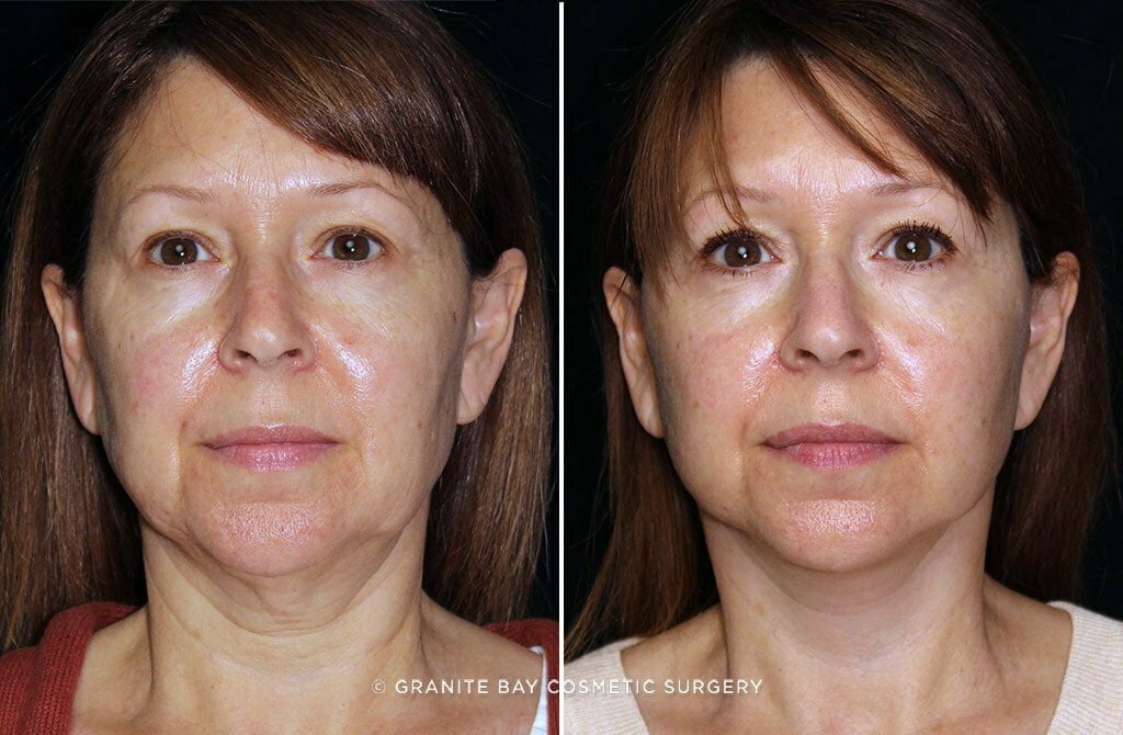 Before and after mini facelift at Grantie Bay Cosmetic Surgery