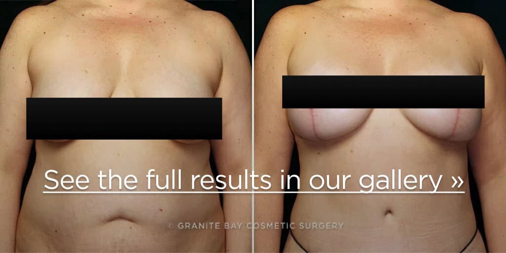 Granite Bay Cosmetic Surgery real patient before and after breast augmentation with implants