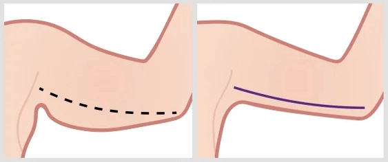 arm lift incision graphic