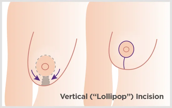 Vertical ("Lollipop") incision graphic