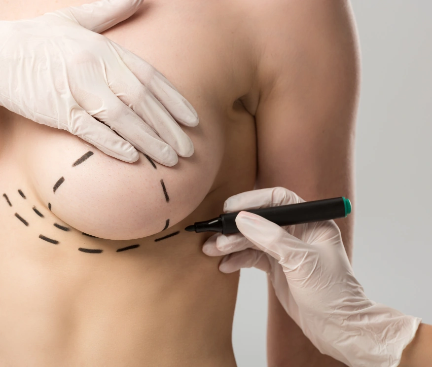 Breast lift incision marking
