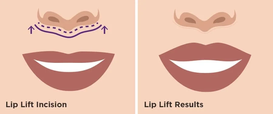 lip lift incision graphic