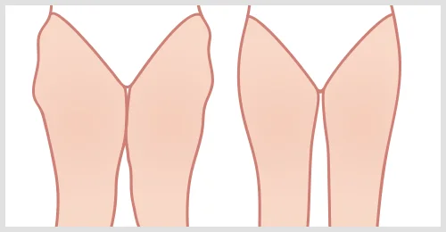 thigh lift incision graphic