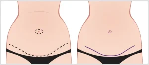 tummy tuck incisions