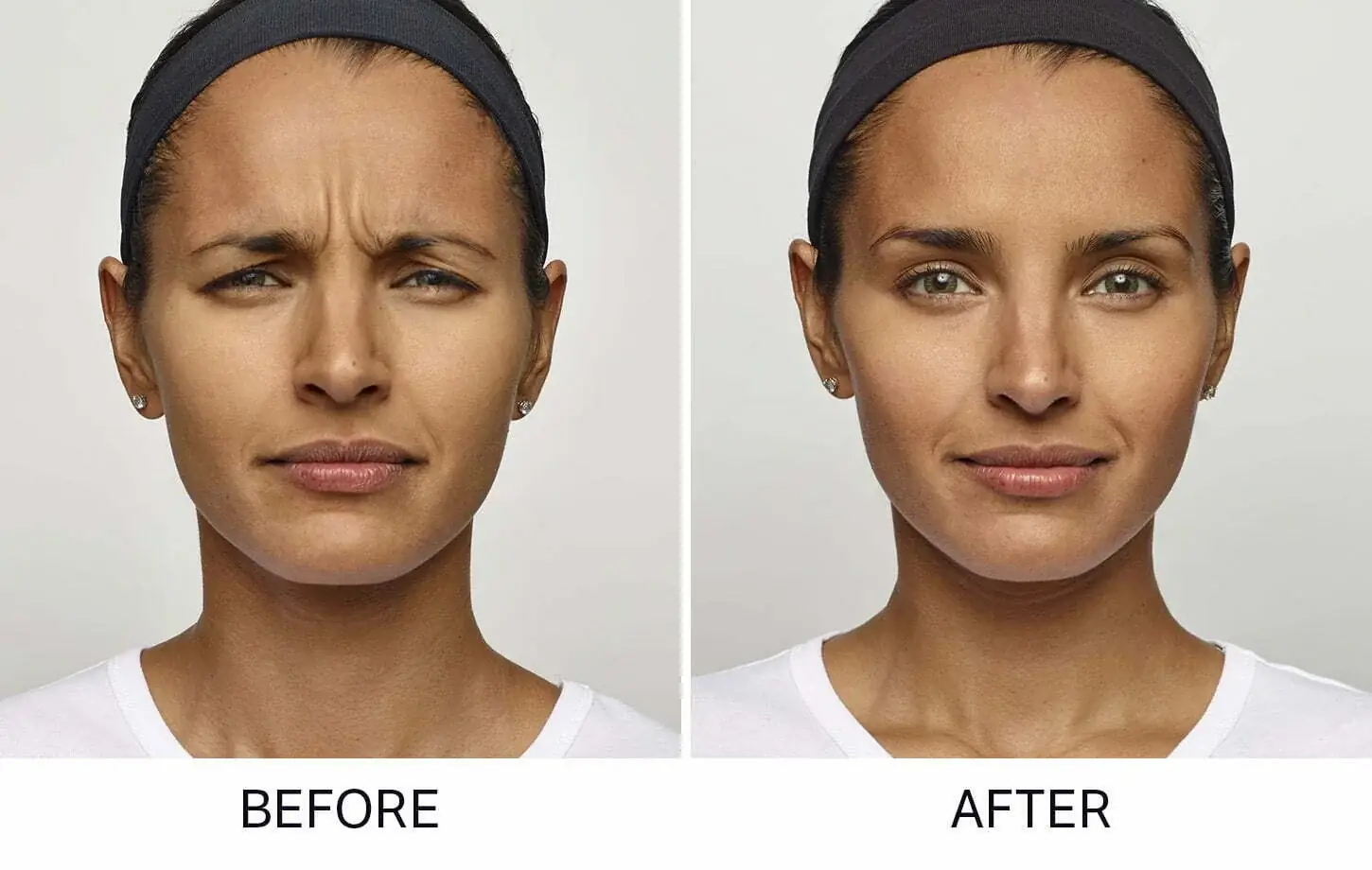 Dysport results before and after