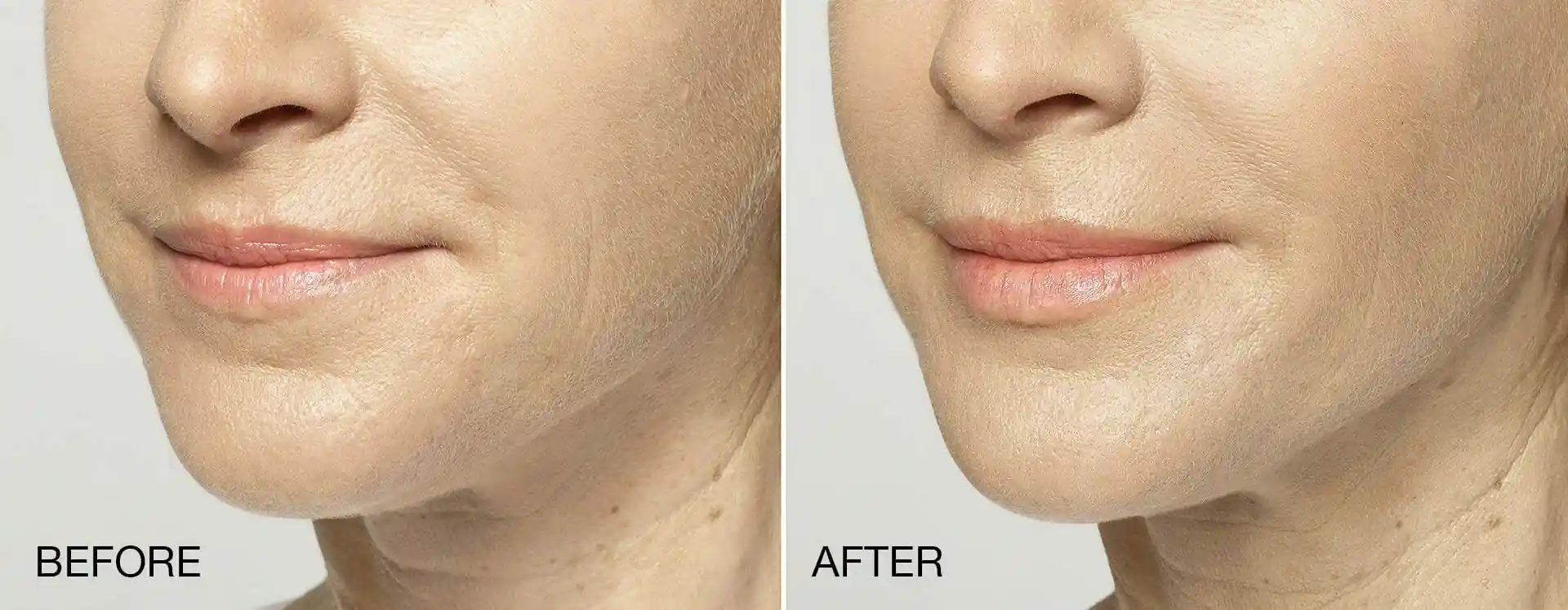 Restylane results around mouth