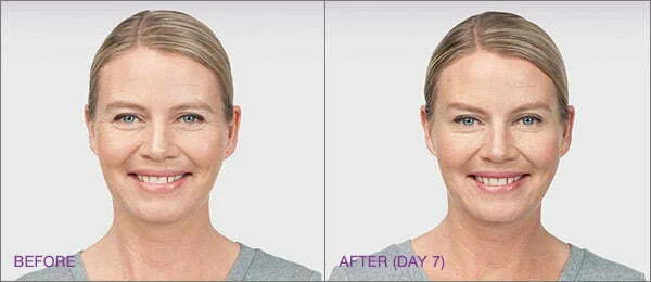 BOTOX results before and after