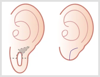 ear lobe incisions graphic