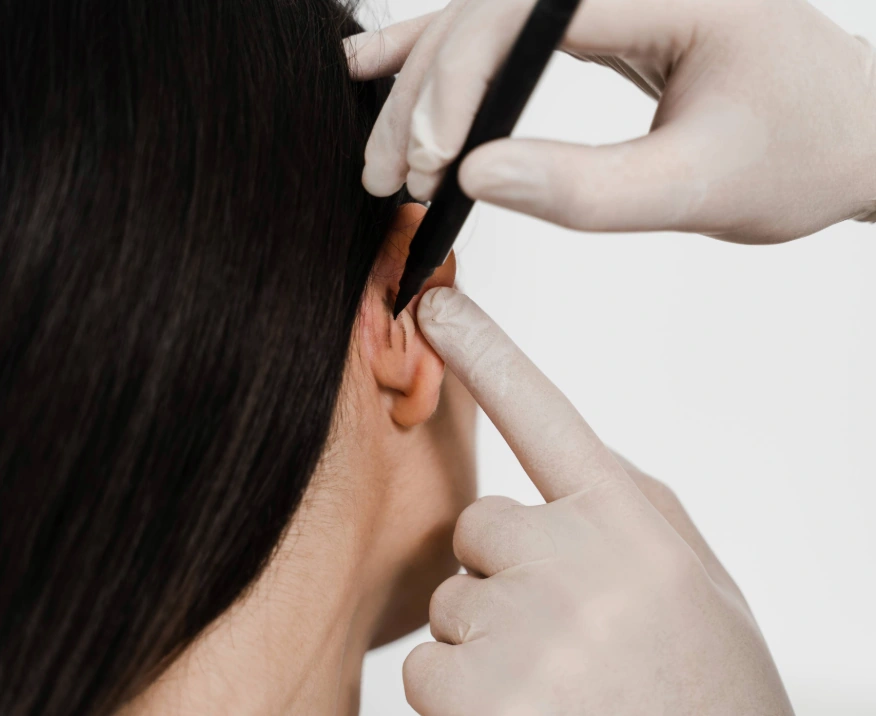 plastic surgeon drawing incision markings on back of patient's ear for ear pinning procedure