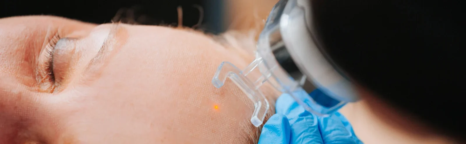 laser resurfacing treatment