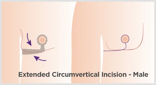 gynecomastia incision extended graphic