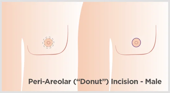 gynecomastia incisions peri-areolar graphic
