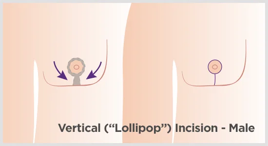 gynecomastia incisions vertical graphic