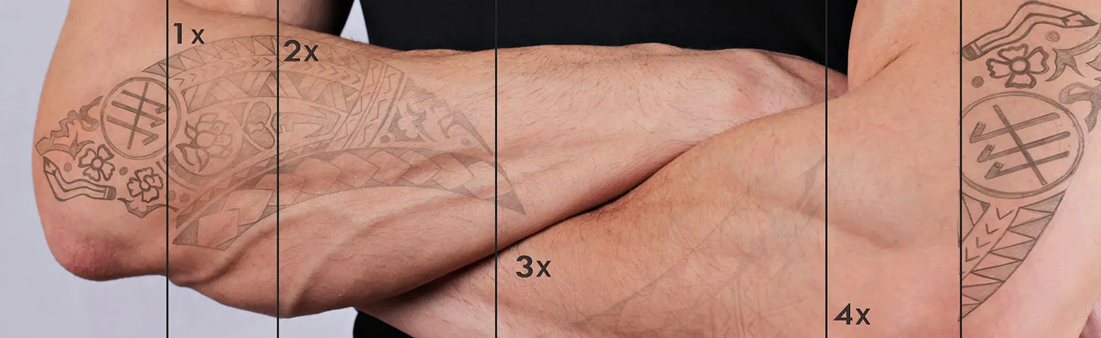 Laser tattoo removal before and after