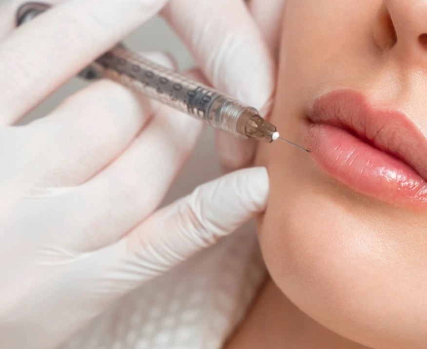 lip filler injections