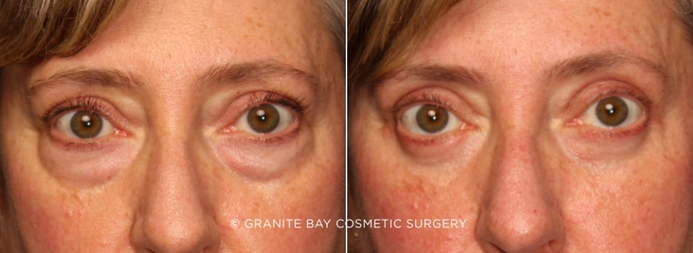 Case # 17 before photo