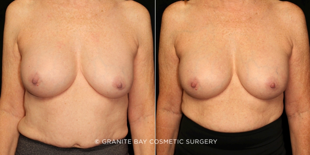 Case # 90 before photo