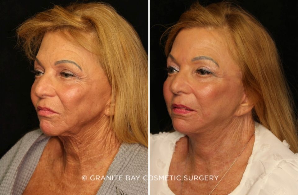 Case # 4 before photo