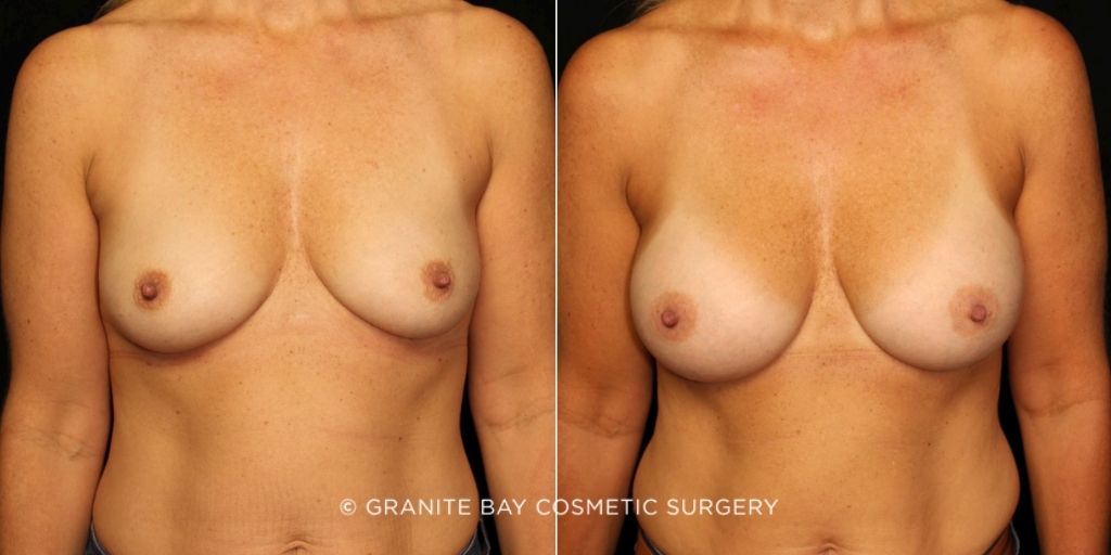 Case # 171 before photo