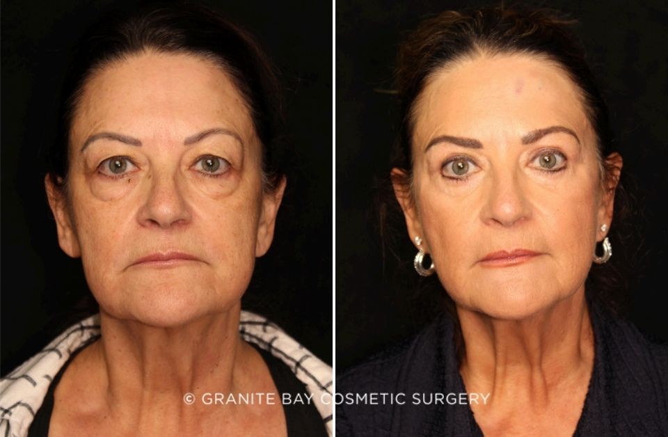 Case # 11 before photo