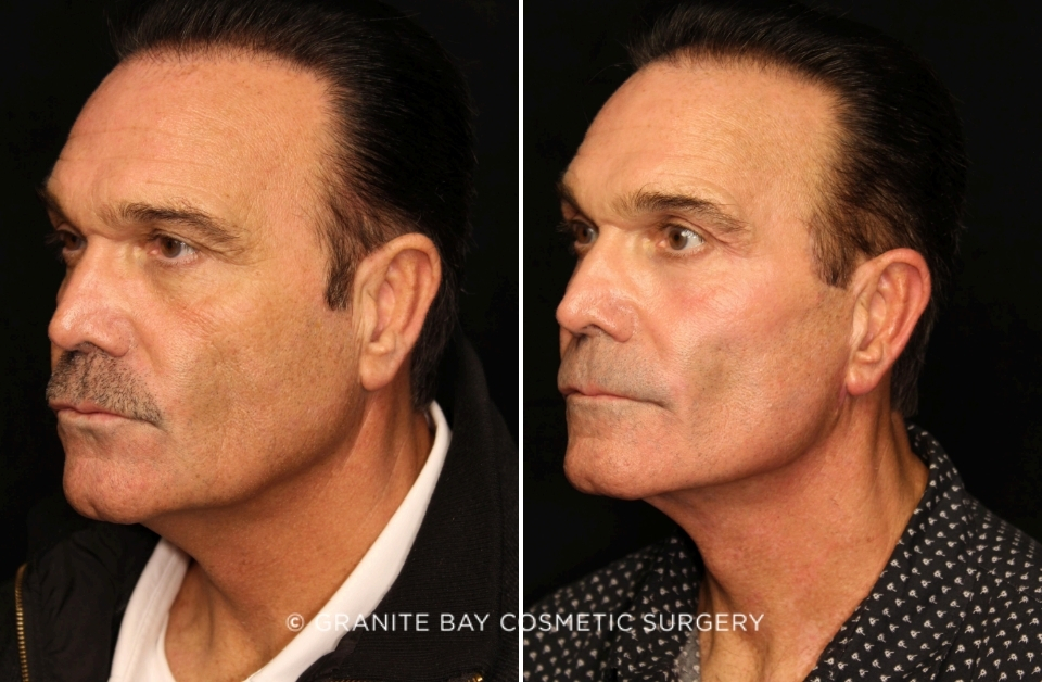 Case # 5 before photo