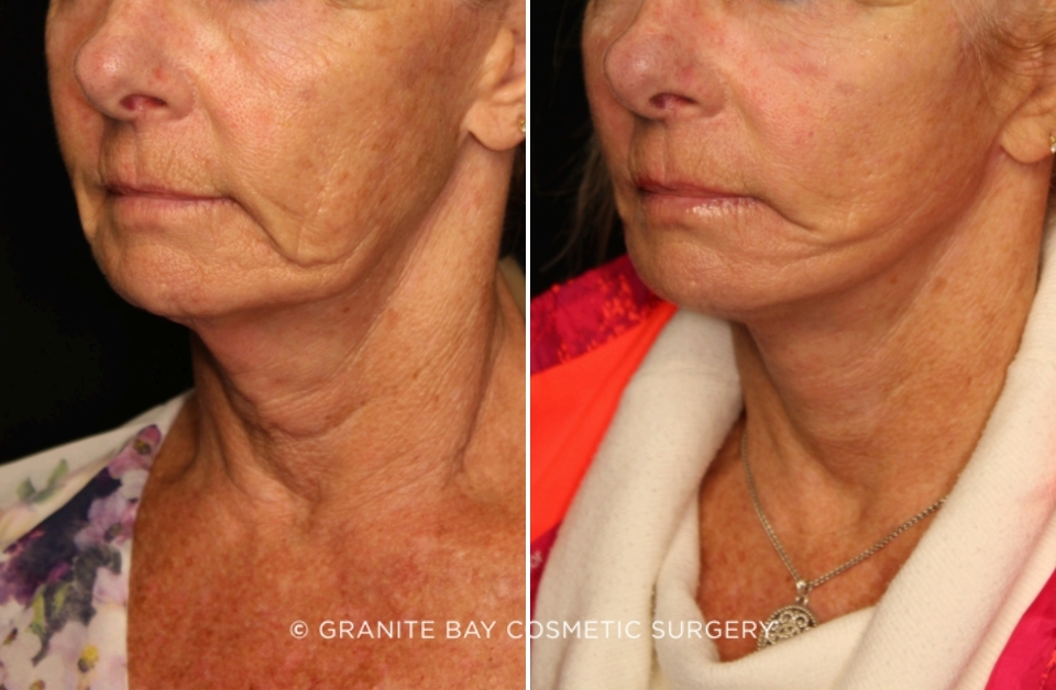 Case # 6 before photo