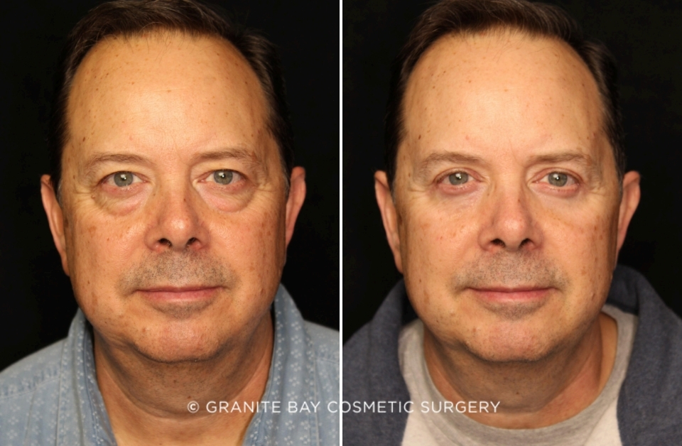 Case # 14 before photo